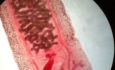 Anquilostomosis cilvēkiem